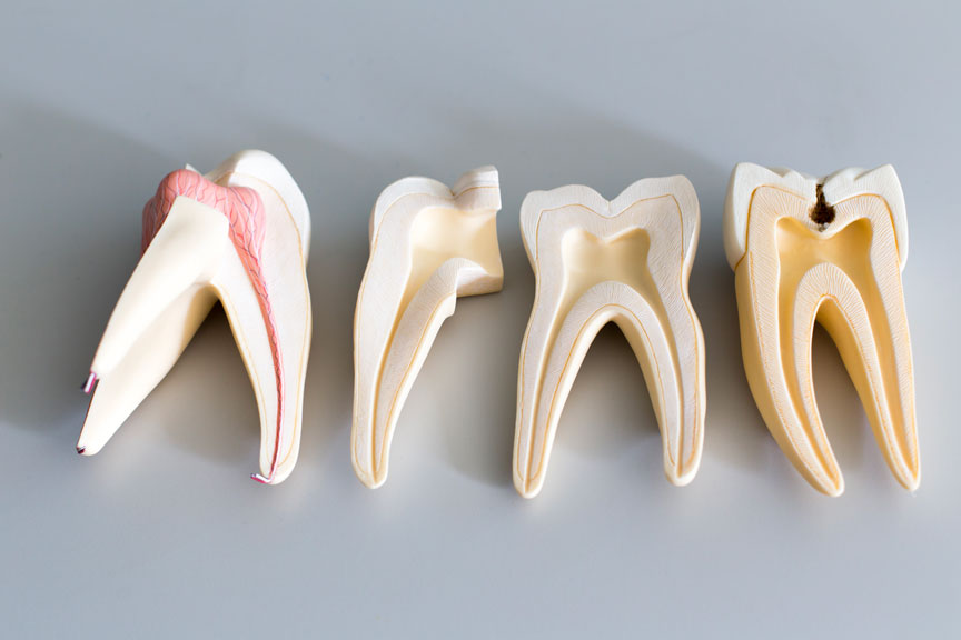 Options for Cavity Fillings - Root Canal Treatment