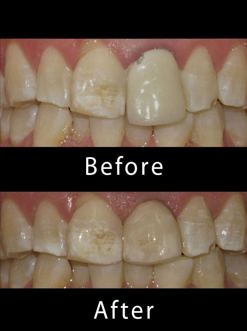Dental Veneers Before After Image