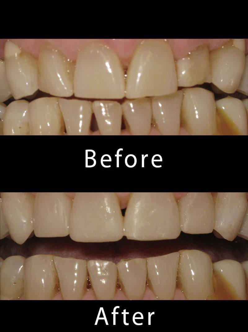 Dental Veneers Before After Image