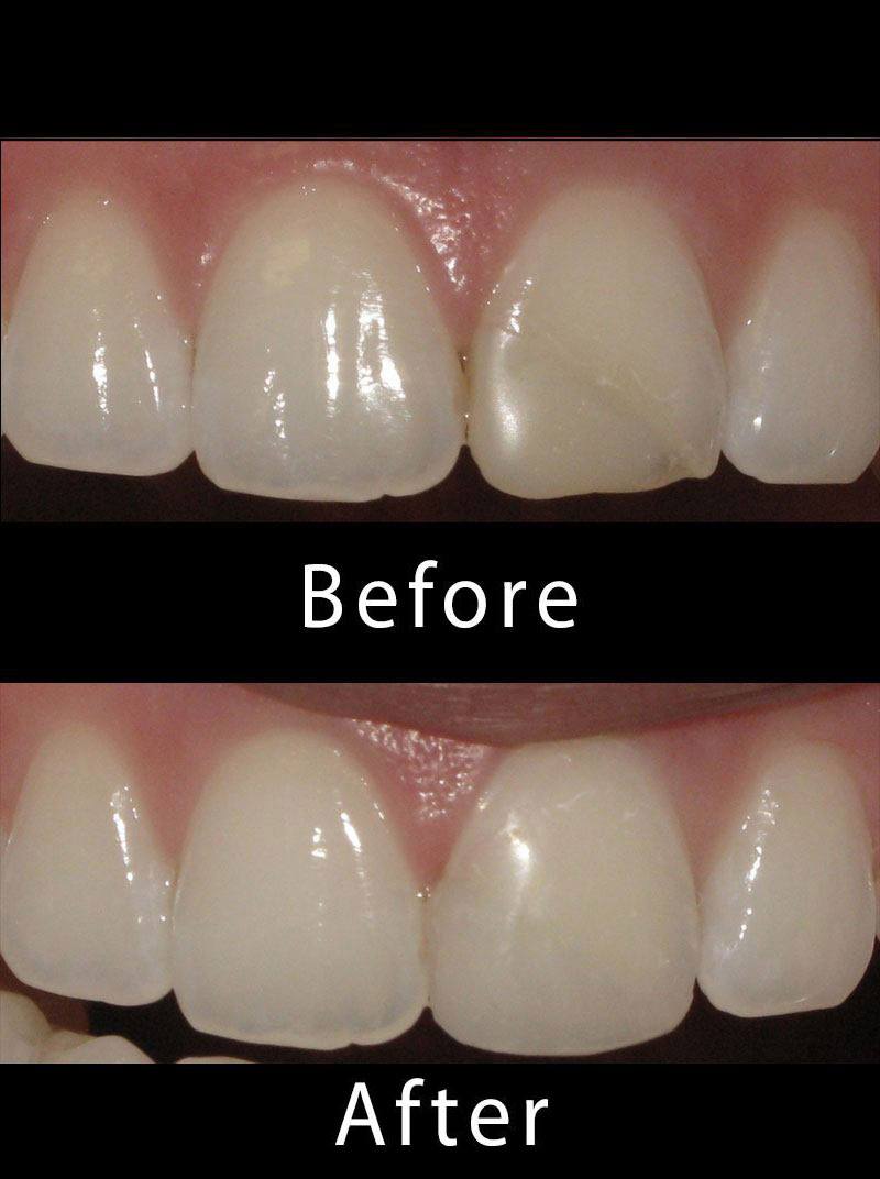 Dental Dentures Before After Image