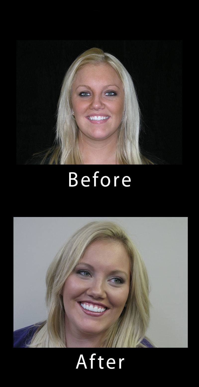 Smile Makeover Before After Image