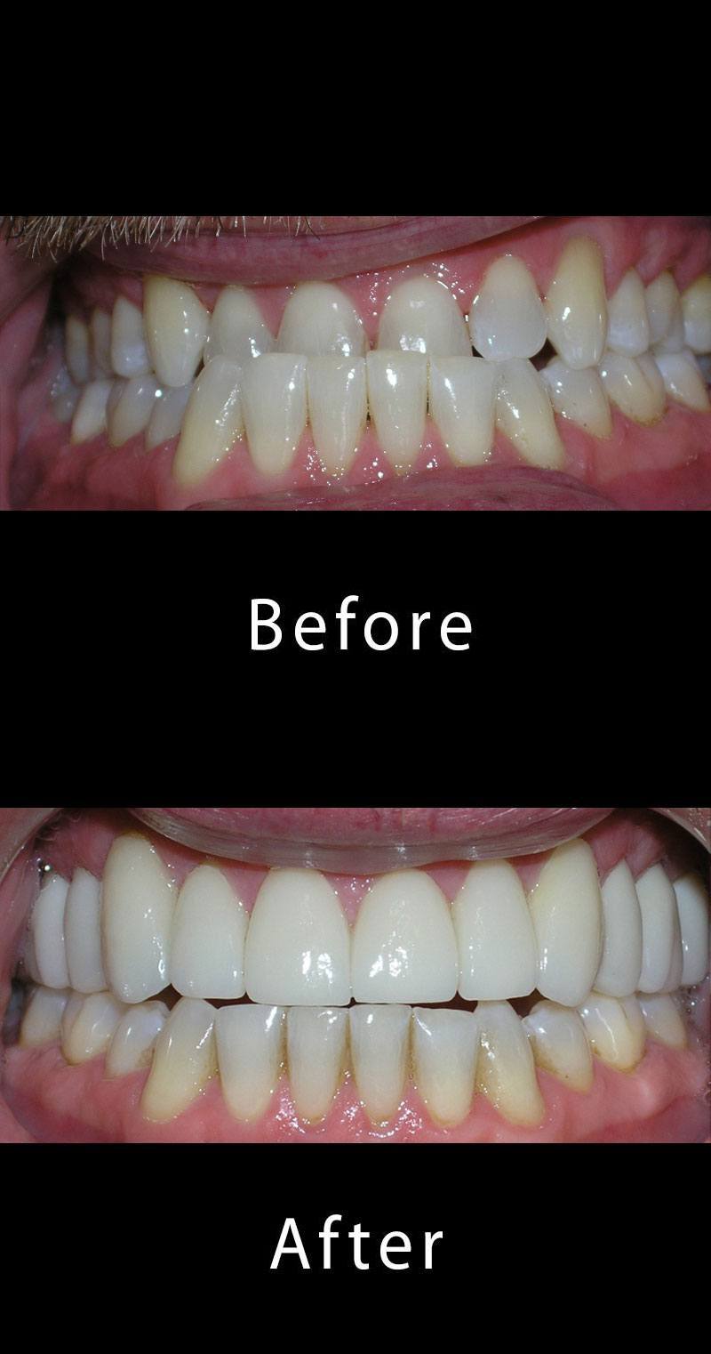 Teeth Whitening Before After Image