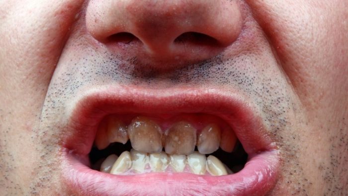 3 Types of Tooth Stains and How to Remove Them