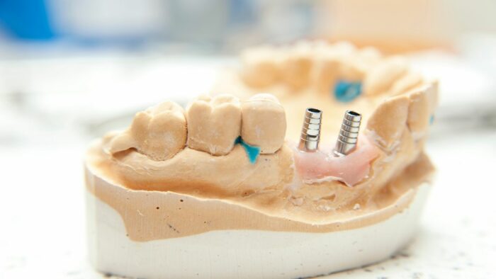 Dental Bridge Vs. Implant: Which Is Right For You?