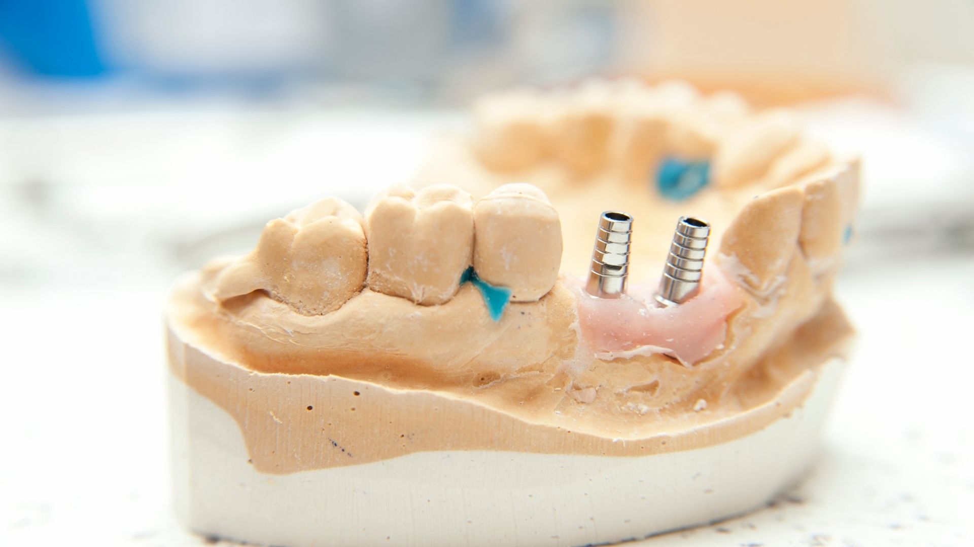 Dental Bridge Vs. Implant: Which Is Right For You?