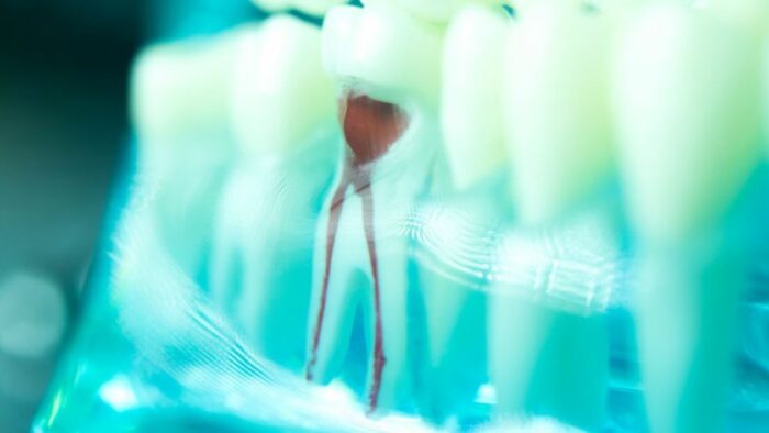 Everything to Know About How Long Root Canals Last
